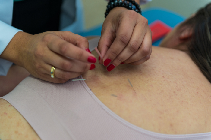 Acupuntura 